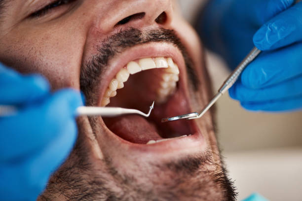 Best Broken or Cracked Tooth Emergency Dentist in Crownsville, MD