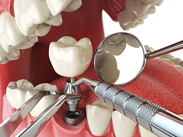 Best Emergency Dental Extractions in Crownsville, MD